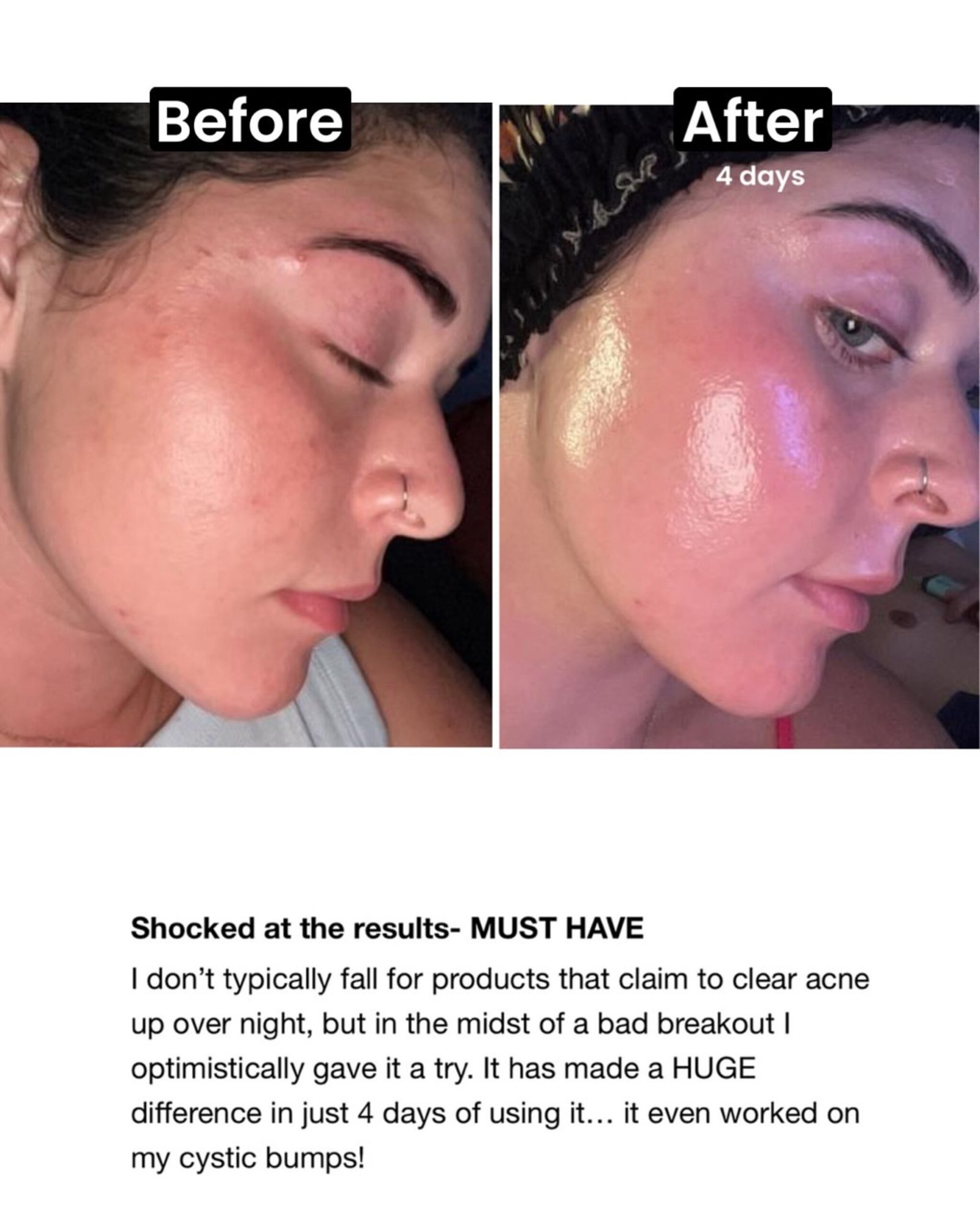 The INKEY List Blemish Clearing Moisturizer with 2% Novoretin - Image 3